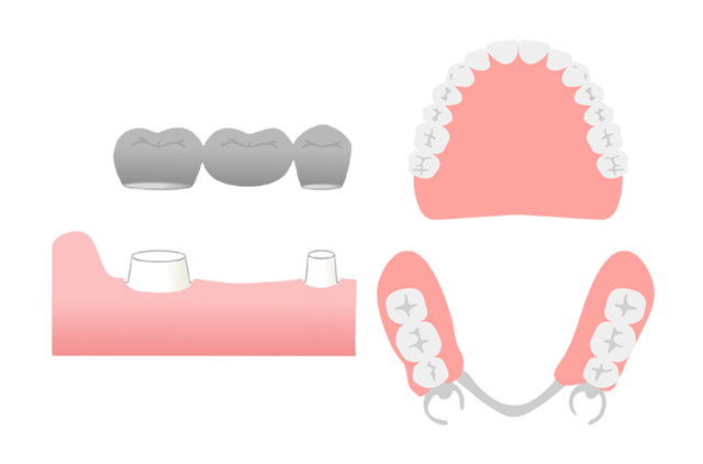 入れ歯・ブリッジ